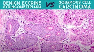 Eccrine Syringometaplasia  benign reactive mimic of squamous cell carcinoma dermpath pathology [upl. by Dorrehs911]