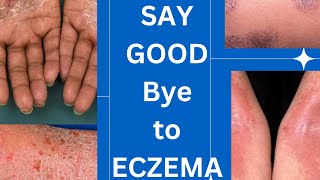 Management guidelines of eczema skin specialist advice How to treat eczemaskinhealthvitality5959 [upl. by Novej]