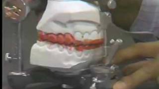 Occlusal Adjustment  Centric Relation [upl. by Reerg]