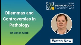 Dilemmas and Controversies in Pathology  Dr Simon Clark  Virtual Dermoscopy Masterclass 2020 [upl. by Sada]