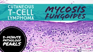 Mycosis Fungoides Cutaneous TCell Lymphoma 5Minute Pathology Pearls [upl. by Vala628]