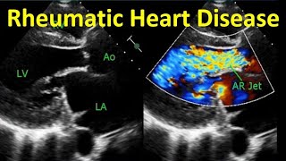 Rheumatic Heart Disease [upl. by Locklin]