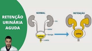 RETENÇÃO URINÁRIA AGUDA  BEXIGOMA [upl. by Vahe629]