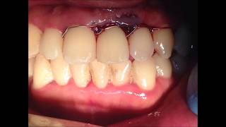 tratamiento de fractura dentoalveolar  Treatment of Dentoalveolar Fracture [upl. by Monk]