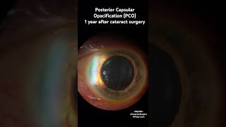 Posterior Capsular Opacification PCO 1 year after cataract surgery OptiRec CustomSurgical [upl. by Yasdnil]