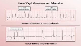 Intro to EKG Interpretation  How to Identify Any Tachyarrhythmia with 6 Easy Questions [upl. by Odnamra]