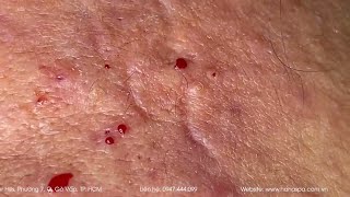 Big Cystic Acne Blackheads Extraction Blackheads amp Milia Whiteheads Removal Pimple Popping [upl. by Inahteb]