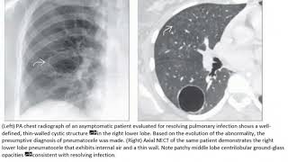 Pneumatocele radiology [upl. by Kristo]