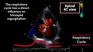 Tricuspid Regurgitation and Respiratory Cycle [upl. by Jephum747]