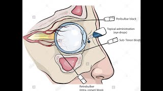 Peribulbar and retrobulbar Block for eye surgery [upl. by Odranreb]