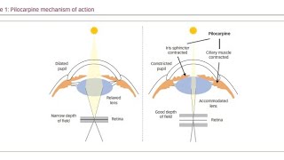 Using Muscarinic Agonist drugs Pilocarpine to treat Glaucoma [upl. by Alemrac631]