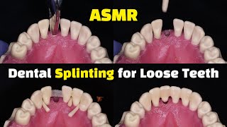 Dental Splinting for Loose Teeth using Ribbond after a Tooth Extraction [upl. by Meagher276]