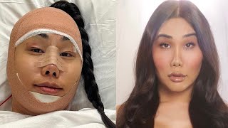 My Facial Feminization Surgery Story  Gia Gunn [upl. by Toll]