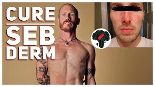 How To Cure Seborrheic Dermatitis Permanently [upl. by Joel157]