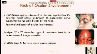 OPHTHALMOLOGY  HZV ADENOVIRAL NUMULAR KERATITIS POST HERPETIC NEURALGIA BY PROF A QUADER [upl. by Ariaz571]