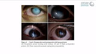 Corneal Hydrops Rethinking Treatment [upl. by Jimmy]