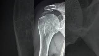 Classic case  Rotator cuff Calcific tendinopathy on plain radiograph radiology calcifictendinosis [upl. by Territus]