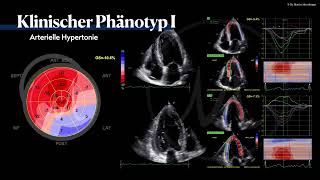 〖Echokardiografie〗 Arterielle Hypertension  HFpEF Phänotyp🫀 [upl. by Aztinay]