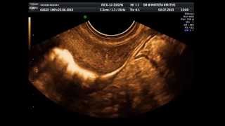 HysterosalpingoContrast Sonography HyCoSy  normal study [upl. by Tat]