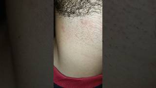 Who can face this problem after shaving beard neckline beard hairissue unfrezzmyaccount [upl. by Loralyn]