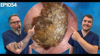 Removing Massive Ear Wax Blockages  EP1054 [upl. by Anasxor]