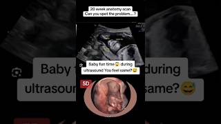 20 weeks anotomy scan fun time on ultrasound😅🫢viralvideo trending viralshorts [upl. by Cirred]