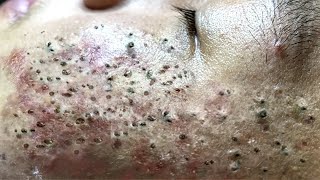 Blackhead Removal With Sac Dep Spa 100074091 [upl. by Fabio]