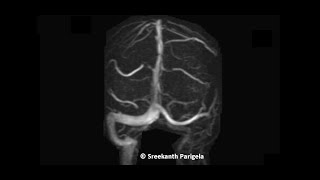 Hypoplastic Left Transverse sinus  MRV [upl. by Neslund]