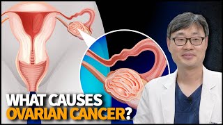 What Causes Ovarian Cancer How to Detect it Early and How to Treat it [upl. by Loring]