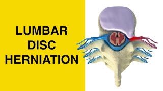 How Herniated Discs Cause Sciatica and Pinched Nerves  Bulging and Slipped Disc [upl. by Patt]