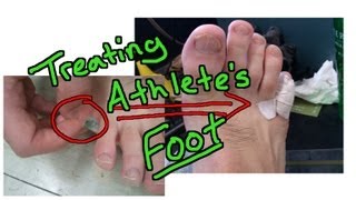 👣 Athletes Foot Part 2  New Simple and Effective Treatment [upl. by Milewski904]