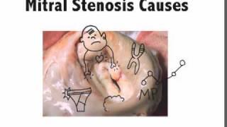 Mitral Stenosis Causes Mnemonic [upl. by Anoik]