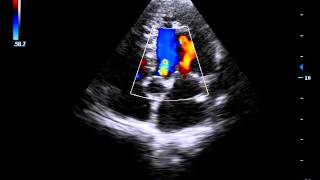 understanding colour Doppler in one minute [upl. by Lienad]