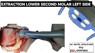 EXTRACTION LOWER SECOND MOLAR LEFT  EXTRACTION LOWER MOLAR  EXTRACTION MOLAR MOLAR EXTRACTION [upl. by Ym]