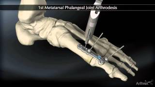 1st Metatarsal Phalangeal Joint Arthrodesis [upl. by Namyac]