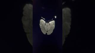 😱Teeth Braces Artifact in mrianatomy radiology shortsvideo radiological shortsviral trending [upl. by Namreg]