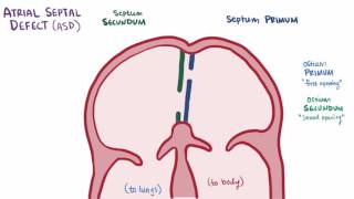 Atrial septal defect ASD repair causes types symptoms amp pathology [upl. by Graniah]