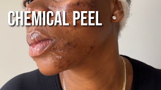 PCA Chemical Peel on Black Skin for Hyperpigmentation and Texture [upl. by Yxor]