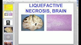 Medical School Pathology 2012 Session 003 Cell Adaptation Injury Death Lecture and Labmp4 [upl. by Kondon641]