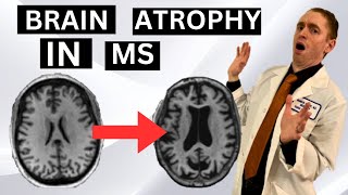 Brain Atrophy in Multiple Sclerosis Explained by Neurologist [upl. by Eisnil270]