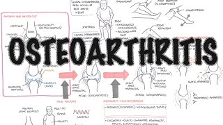 Osteoarthritis Overview causes pathophysiology investigations treatment [upl. by Derinna]