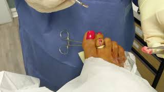 Hammertoe Surgery [upl. by Llerahc]