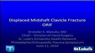 Displaced midshaft clavicle fracture  ORIF vs nonop  Debate [upl. by Yecaj]