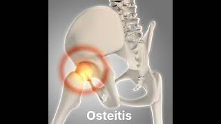 Osteitis inflammation of boneshorts [upl. by Yong]