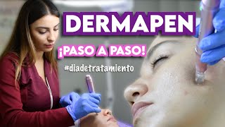 DERMAPEN  TRATAMIENTO DE MICRONEEDLING  Ximena Ramaya [upl. by Anneres]