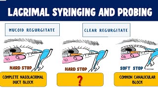 Lacrimal Syringing and Probing  Technique and Interpretation of results [upl. by Hutton]