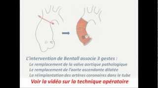 Lintervention de Bentall en 1 minute [upl. by Llaccm587]