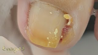 UNHA ENCRAVADA satisfying viral [upl. by Kelley]