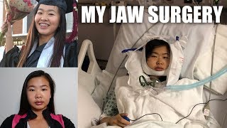 MY JAW SURGERY EXPERIENCE  LeFort I Osteotomy Day 135 of Recovery amp Tips VLOG 11  katyyho [upl. by Yahiya77]