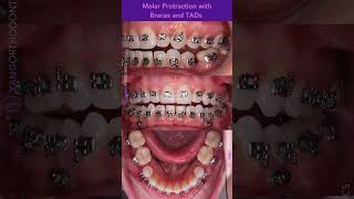 Closing missing tooth space by protracting molars forward with braces and TADs orthodontics [upl. by Retxed]